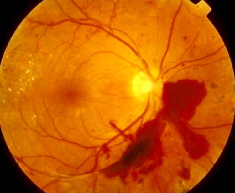 Retina Hasatalıkları Takip ve Tedavisi 