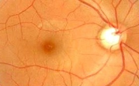 High Eye Pressure (Glaucoma)